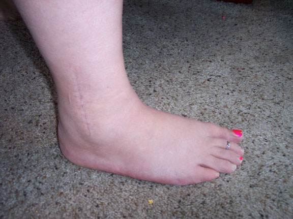 Anterior ankle