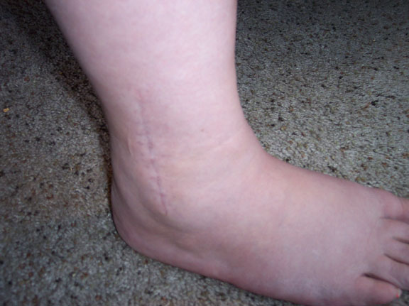 Anterior Ankle Anterior Ankle