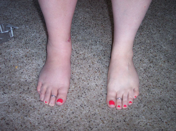 Right vs. Left ankle